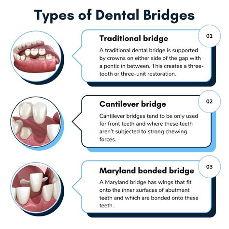 What is a Dental Bridge: Comprehensive Guide - Savannah Dental