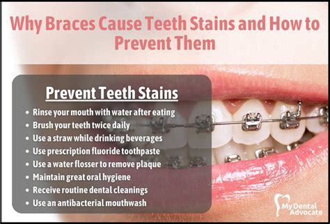 Image result for Teeth Staining Causes