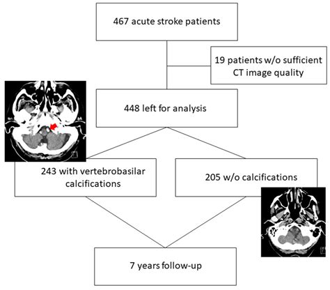 Basilar Artery Stroke