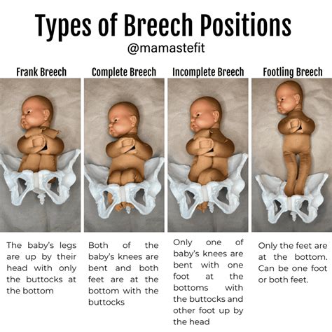 Knee Breech Presentation