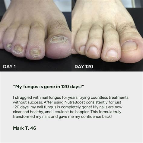 Nail Fungus Treatment Gel – NutraBoost