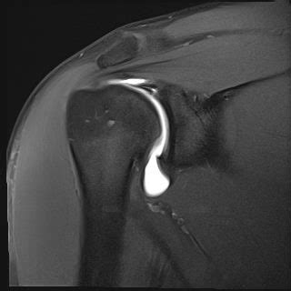 Mr Arthrogram Shoulder 的图像结果
