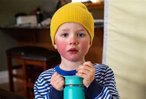 What Does Rosacea Look Like? | The Well by Northwell