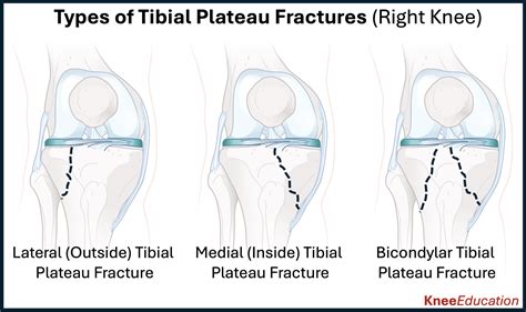 Tibial Plateau Fractures - Knee Education