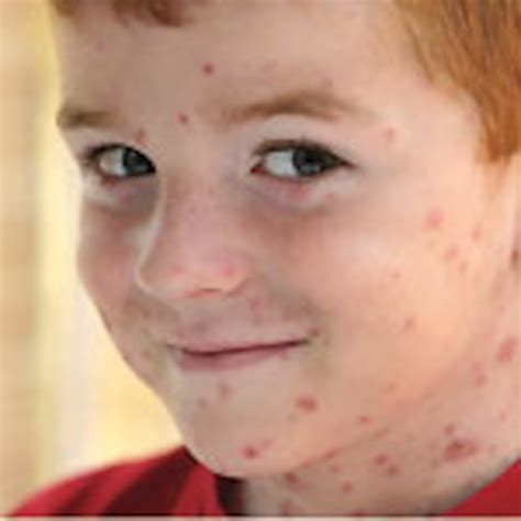 Are you at risk for chickenpox? | Canadian Living