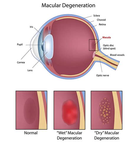 Image result for Macular Degeneration Vision Examples