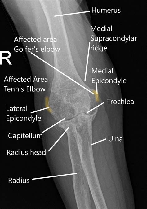 Elbow Joint Pain, Causes and Management | Complete Orthopedics