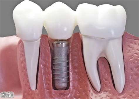 种植牙【多图】_39医疗图集-39健康网