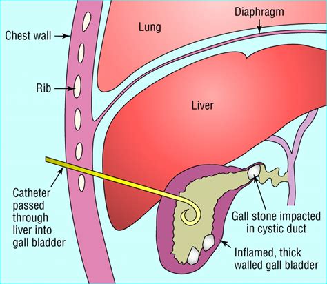 Upper abdominal pain: Gall bladder | The BMJ