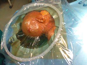 Dr. Partha Pratim Bishnu - India, Kolkata, Brain Tumors, Metastatic ...