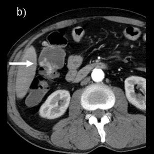Image result for Colonic Diverticulum CT