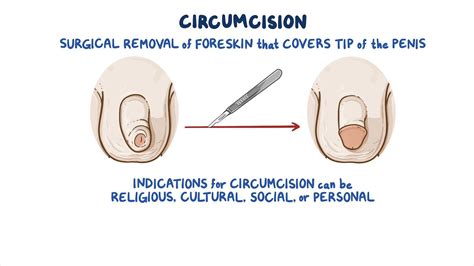 Full Circumcision