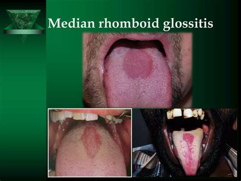 Developmental disorders of tongue elvis chiramel david | PPTX