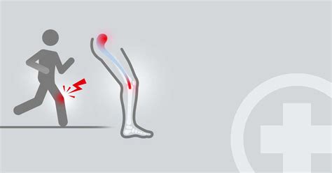 Läuferknie: Runners Knee oder ITBS (Iliotibiales Bandsyndrom ...