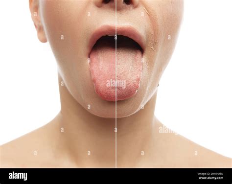 Skin Peel On Tongue