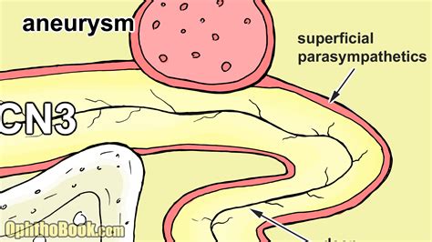 Cranial Nerve Palsies (Video) - TimRoot.com