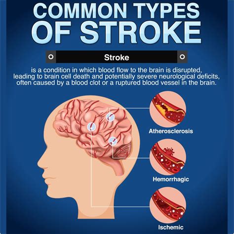 "Stroke Prevention: Lifestyle & Risks"