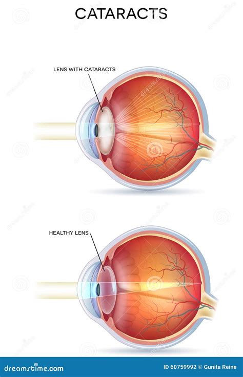Vision Disorder 的图像结果