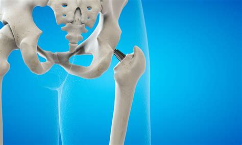 3D Navigation Transforms Hip Replacement: Patient Walks Freely After ...