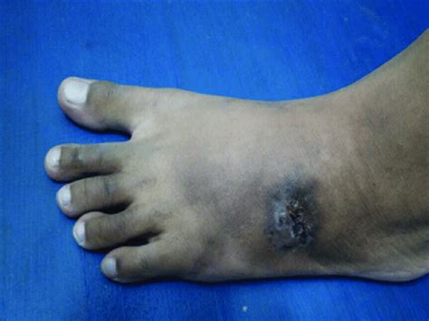 Picture of the left foot after 3 months of antituberculosis therapy ...