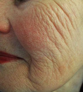 Image result for Profound Face Procedure