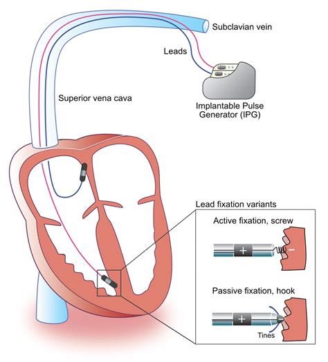Pacemaker Pacing Pathway: Cardiac Pacemaker Settings – WTQM