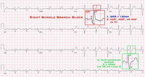 Bundle Branch Blocks - Cardio Guide