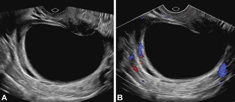 Benign-appearing Incidental Adnexal Cysts at US, CT, and MRI: Putting the ACR, O-RADS, and SRU ...