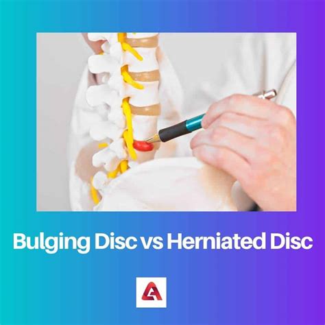Bulging Disc vs Herniated Disc: Difference and Comparison
