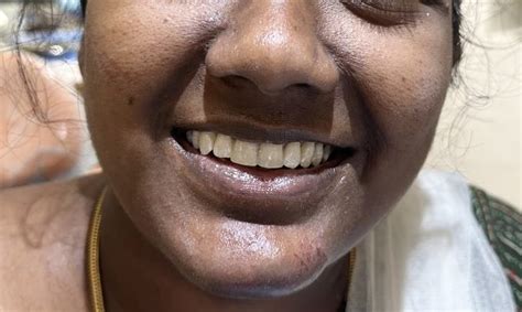 Cosmetic Dentistry - Edens dental and face hospital