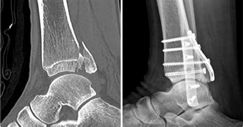 Классификация переломов заднего края большеберцовой кости Bartonıcek ...