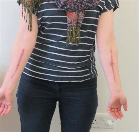 Self-harm scar revision | BMJ Case Reports