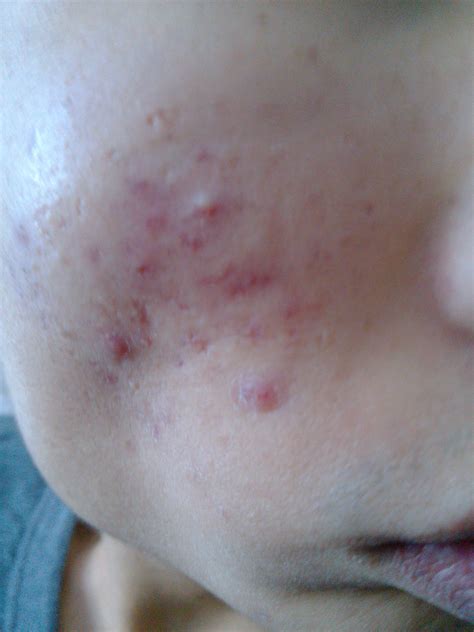 我脸颊两侧长的什么痘痘？什么类型的?长了快两年了有什么办法能治好？_百度知道