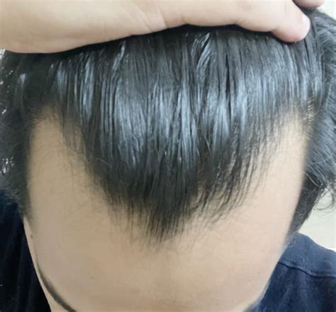 Widows Peak Vs Straight Hairline Widow's Peak Vs. Receding Hairline: