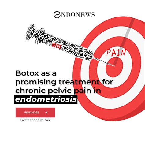 Botox as a promising treatment for chronic pelvic pain in endometriosis ...