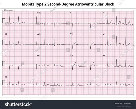 Third Degree Av Block