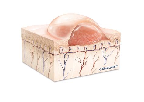 Blister | Should You Pop Blisters? | Elastoplast UK