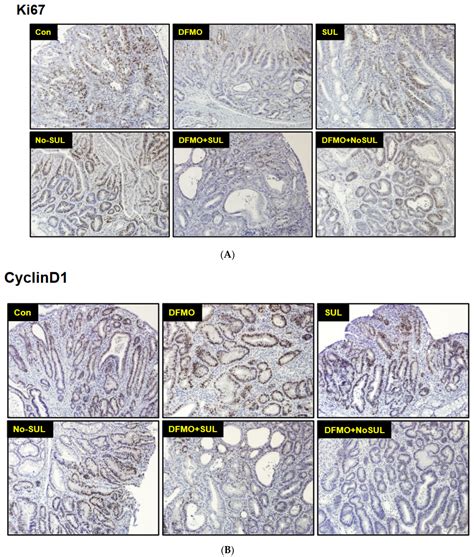 Chemoprevention of Colon Cancer by DFMO, Sulindac, and NO-Sulindac ...
