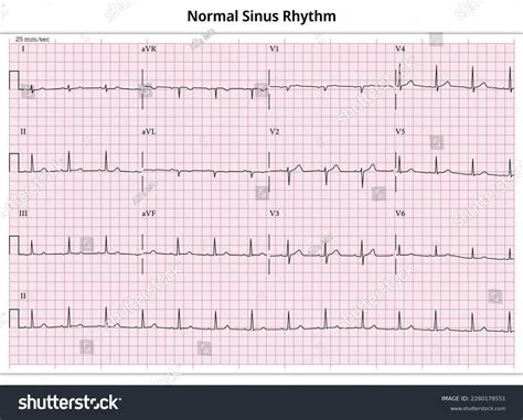 Nsr On Ecg