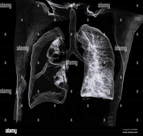 3D computed tomography (CT) scan of the chest of a 60 year old male ...