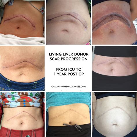 Kidney Donor Scar Location at Hayley Stokes blog