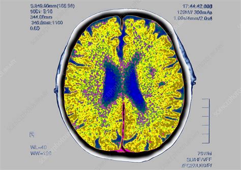 Image result for Add Brain Scan