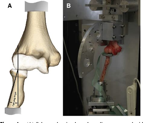 Prosthetic Radial Head 的图像结果