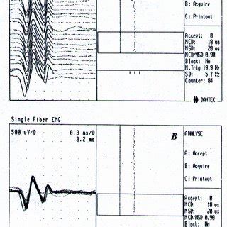 Image result for Single Fiber EMG Test