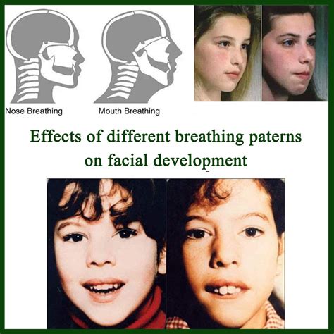 Difference Between Mouth Breathers And Nose Breathers at Teresa Stauffer blog