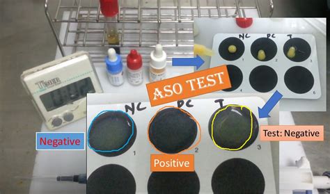 ASO test: Introduction, principle, procedure, normal range,result and
