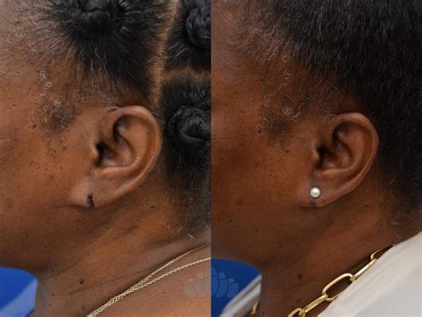 Earlobe Repair Before and After Pictures Case 78 | Charlotte, NC | Dilworth Facial Plastic Surgery