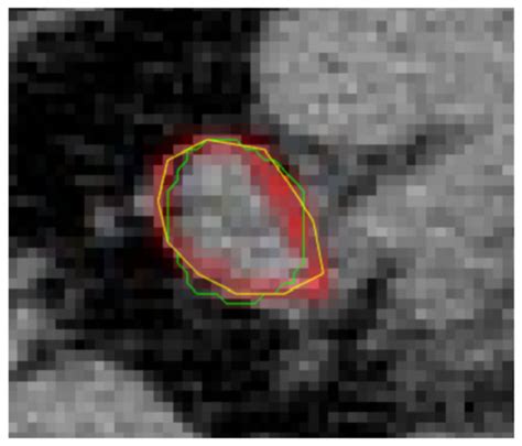 Intelligent Labeling of Tumor Lesions Based on Positron Emission ...