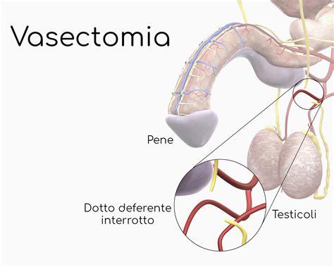 Que Es La Vasectomía Femenina _ Vasectomía: qué es, síntomas y tratamiento – CYUL