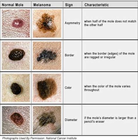 Malignant Melanoma - the mole in the skin! | hubpages